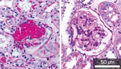 Fig. 1: Stained kidney cells showing the development of severe sclerosis with excess extracellular matrix (red) in glomerular cells from normal mice (left) but not in Mdk-deficient mice (right).