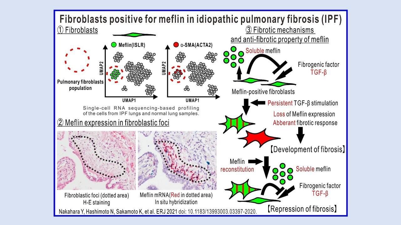 Fibroblasts positive for meflin in idiopathic pulmonary fibrosis (IPF)
(Credit: Nakahara Y, Hashimoto N, Sakamoto K, et al. ERJ 2021 doi:10.1183/13993003.03397-2020)