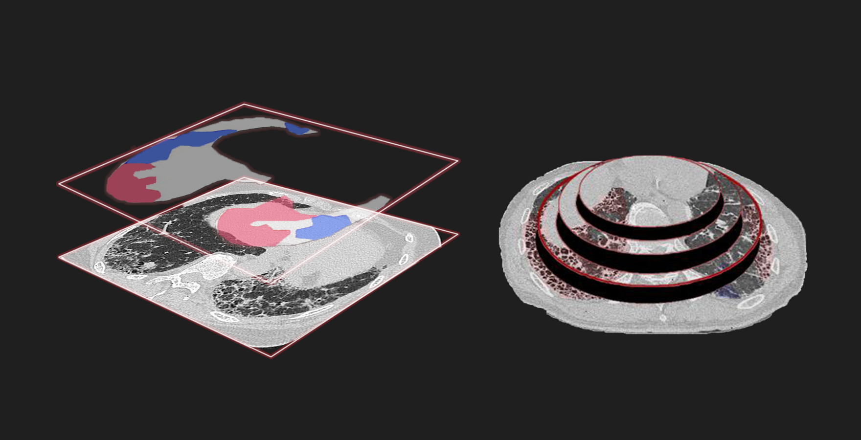 An example of analysis using deep learning.The AI suggested that the red area is idiopathic pulmonary fibrosis and blue area is non-idiopathic pulmonary fibrosis.
(Credit: Tosei General Hospital, Reiko Matsushita)