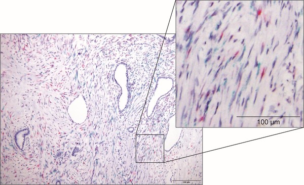 Figure: *In situ* hybridization data showing the infiltration of Meflin-positive fibroblasts (magenta) and -negative ones (green) in human pancreatic cance. Credit: Yasuyuki Mizutani