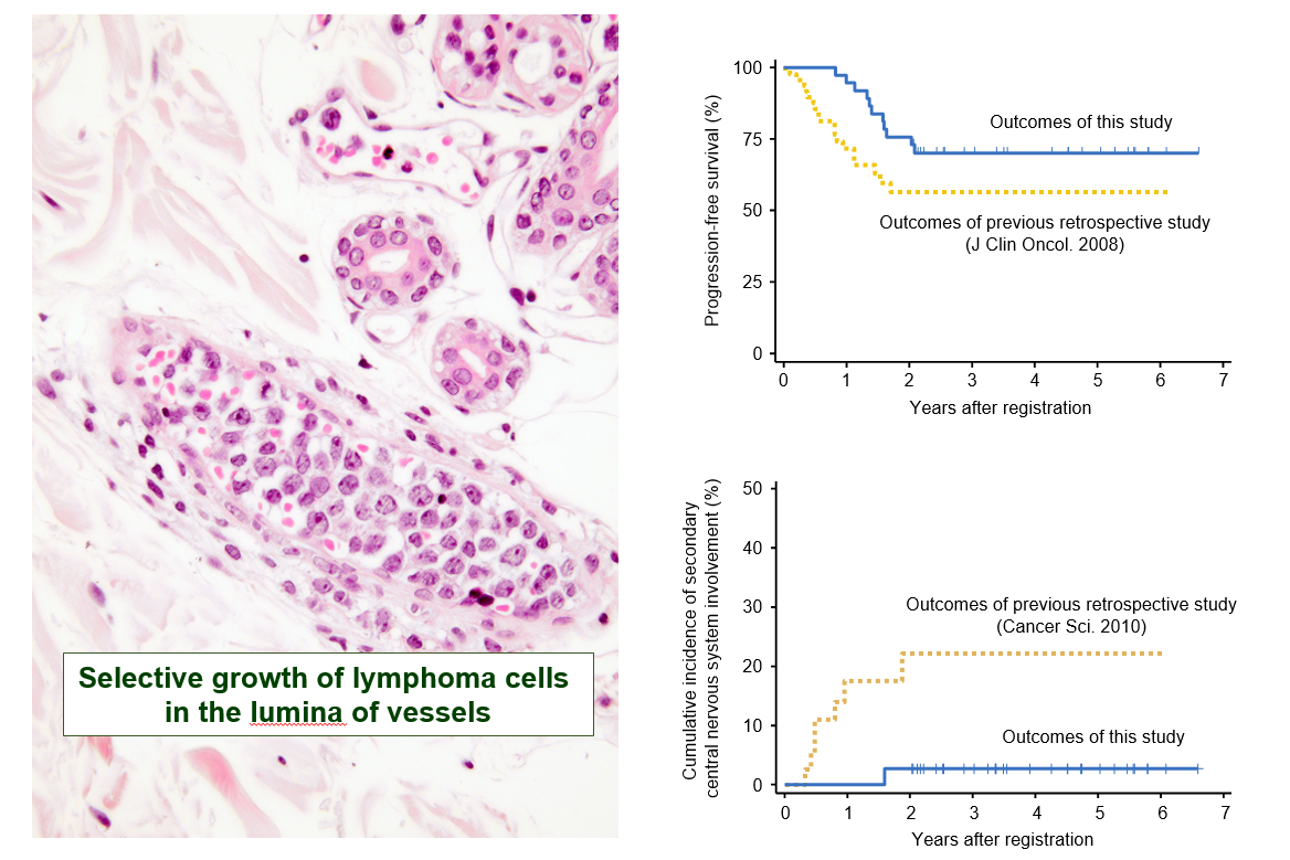 Novel therapy in intravascular large B-cell lymphoma Credit: Kazuyuki Shimada