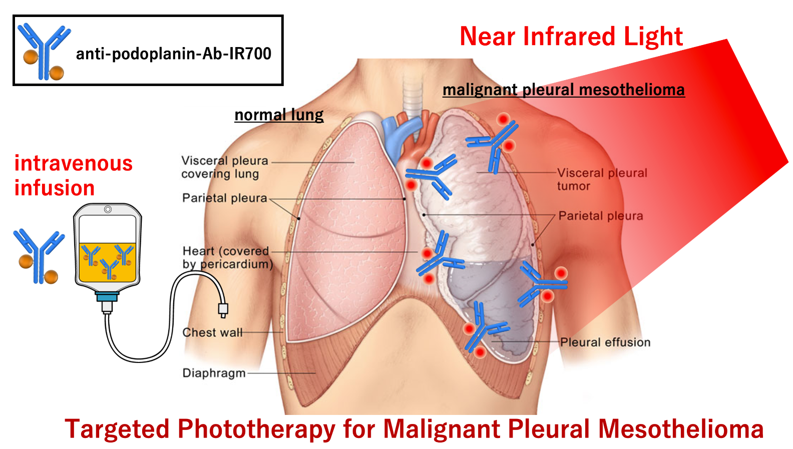 The therapy could involve injecting a podoplanin antibody conjugated with a photoabsorber and then shining near-infrared light into the chest cavity. (Credit: Kazuhide Sato)