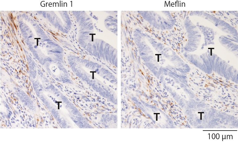 Representative images of human colon cancer tissue showing the localization of gremlin 1-positive (left) and meflin-positive (right) cancer-associated fibroblasts (CAFs) in the stroma. Brown denotes CAFs that are positive for gremlin 1 or meflin T, tumor cells. (Credit: Atsushi Enomoto)