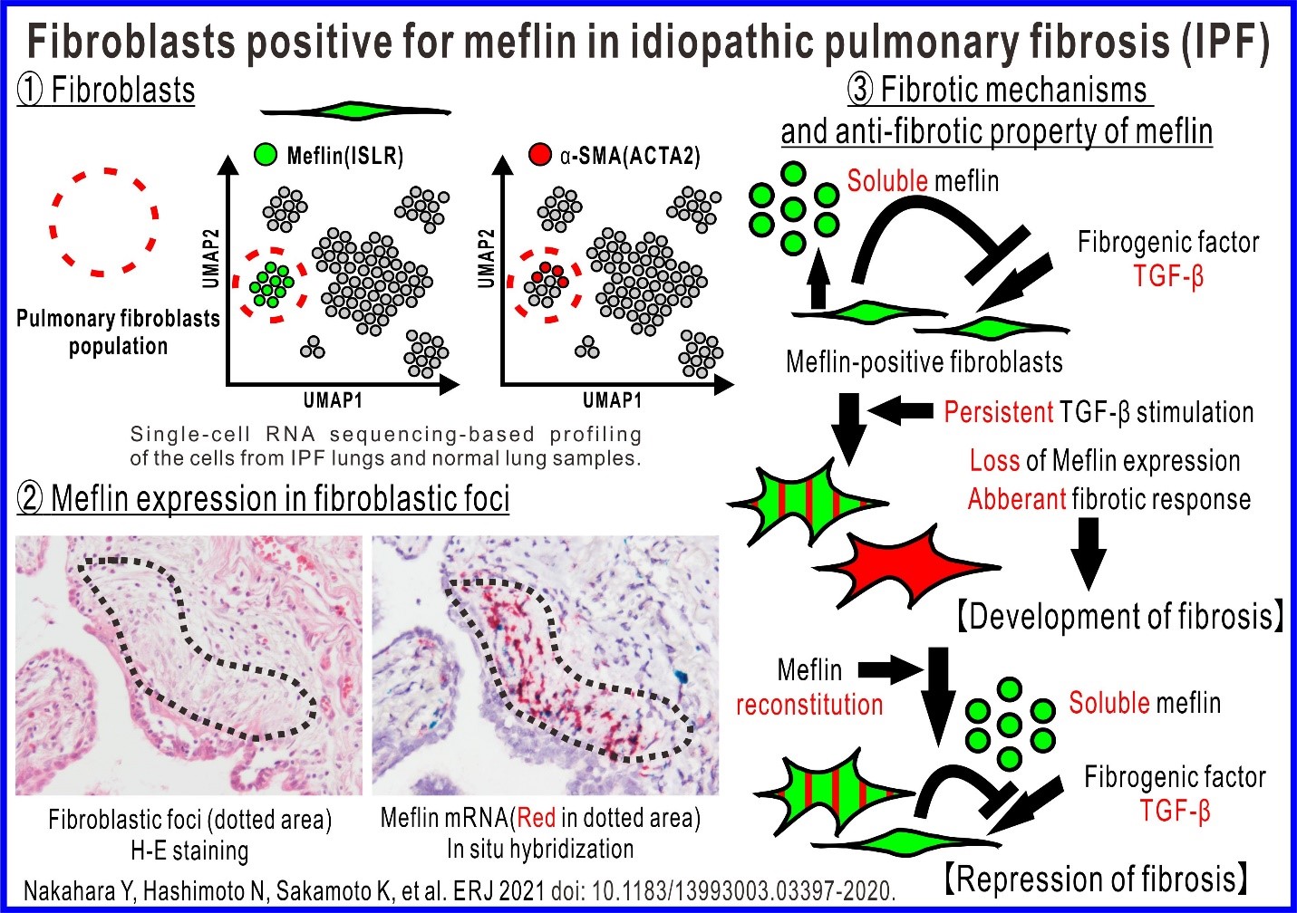 Fibroblasts positive for meflin in idiopathic pulmonary fibrosis (IPF) (Credit: Nakahara Y, Hashimoto N, Sakamoto K, et al. ERJ 2021 doi:10.1183/13993003.03397-2020)