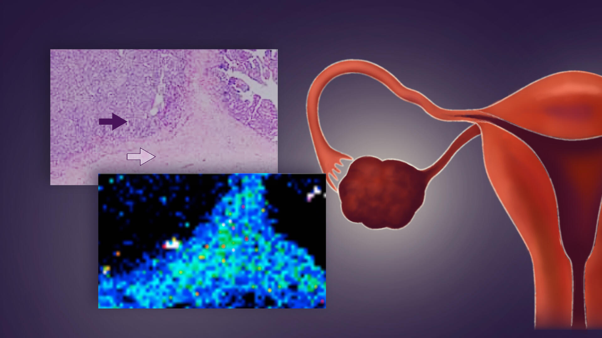 Diagnosing resistance to ovarian cancer treatment more effectively using the distribution of platinum