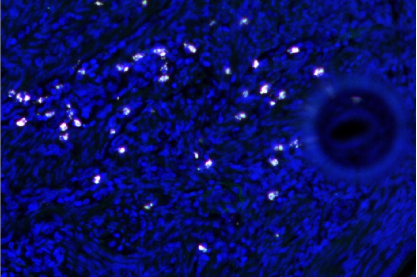 Elimination of type of bacteria suggests treatment for endometriosis