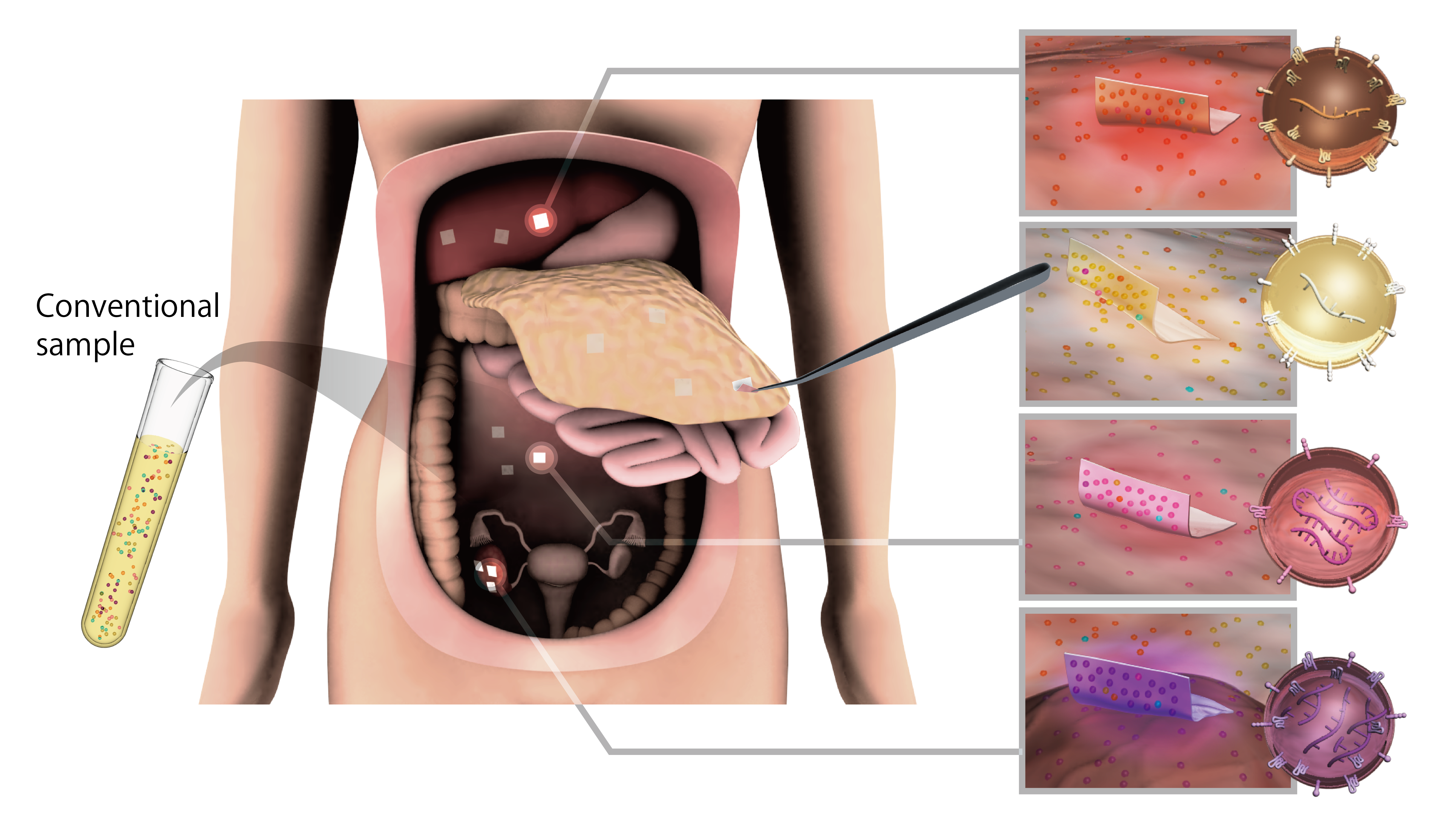 Extracellular vesicles captured using sustainable wood cellulose-based nanofiber sheets may identify and improve cancer treatment