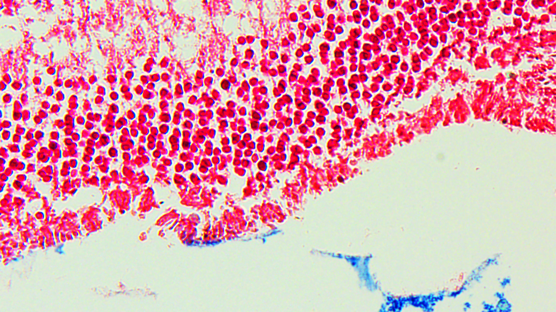 The role of iron in blindness caused by ocular toxoplasmosis