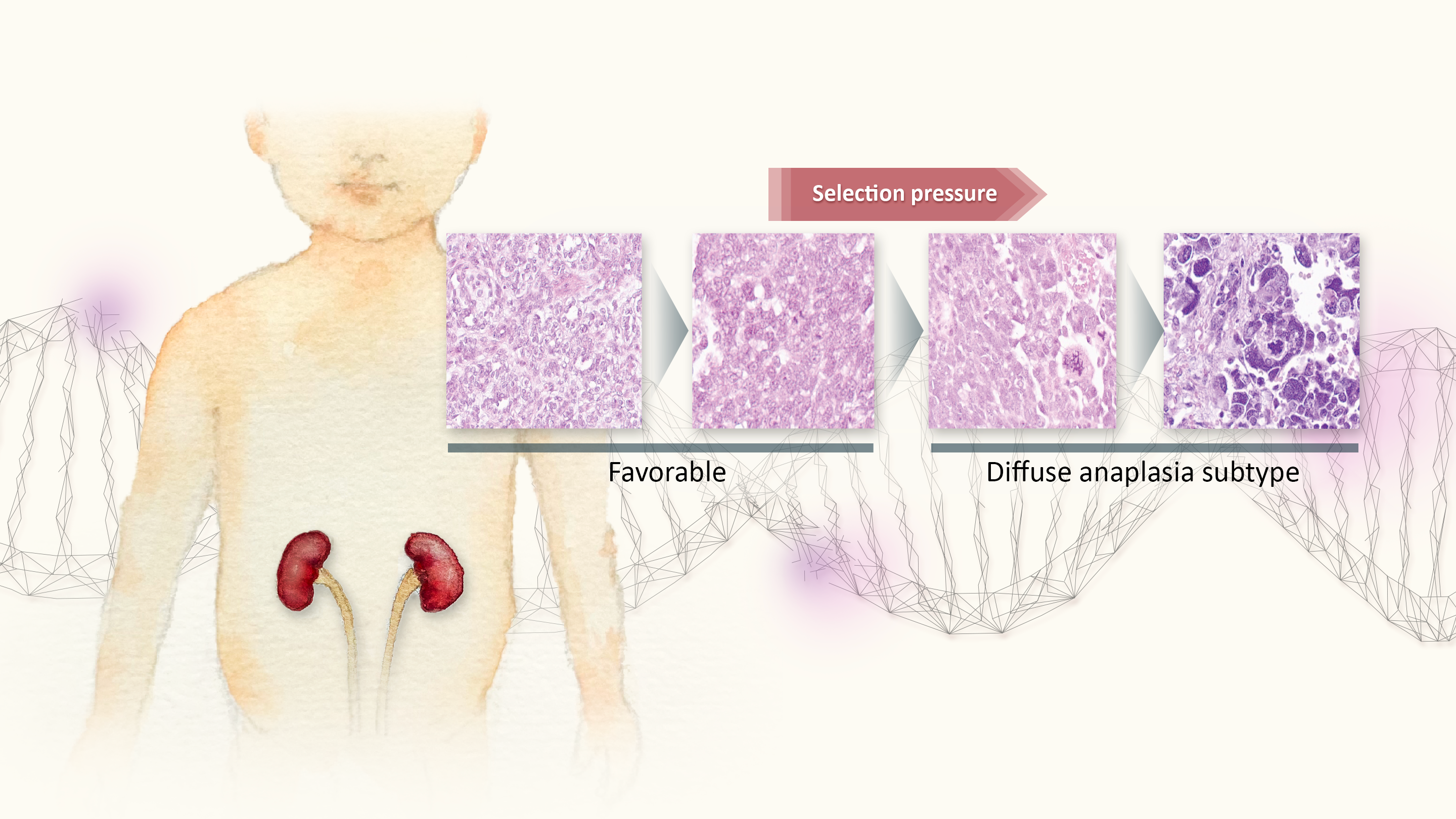 Some tumors ‘grow bad’: Why a dangerous subtype of Wilms tumor is so resistant to chemotherapy