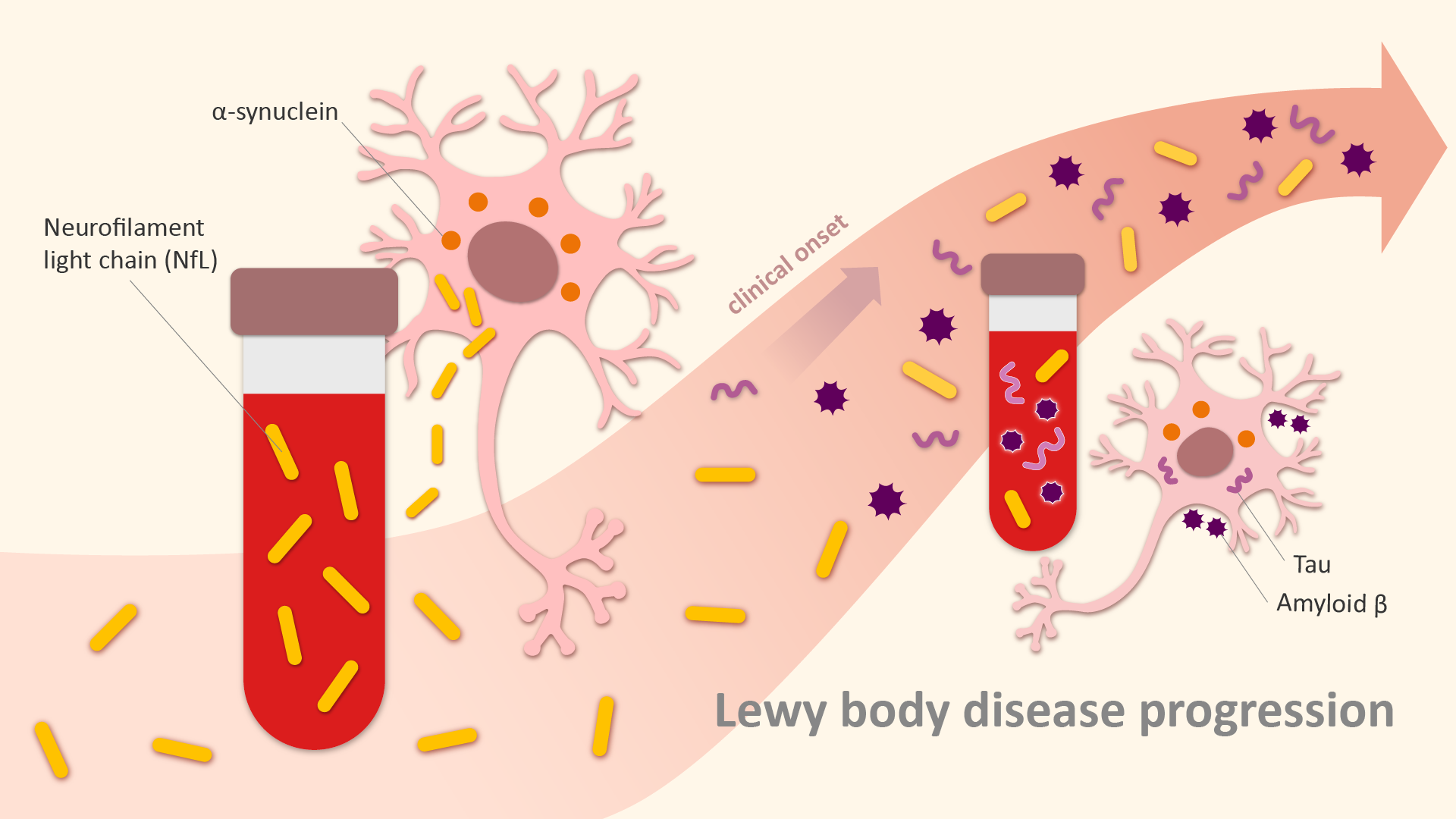 Blood proteins may help to track the pathological progression of Lewy’s body disease