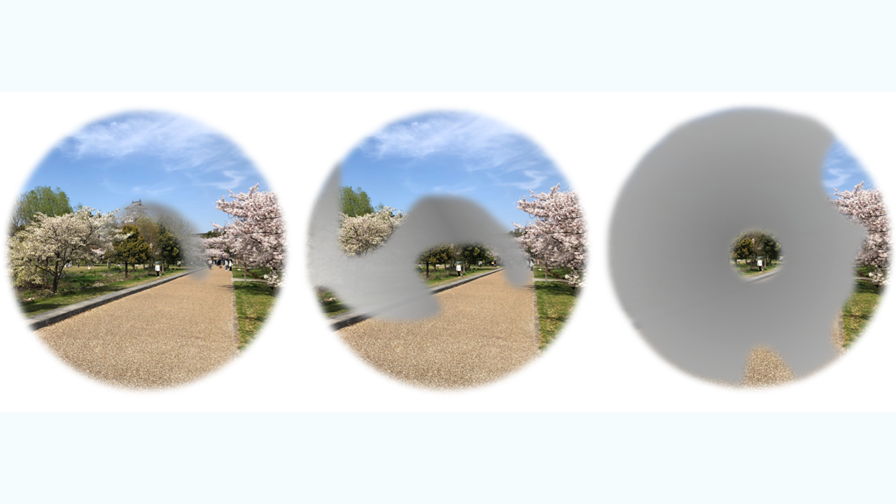 Common eye ointment can damage glaucoma implants, study warns