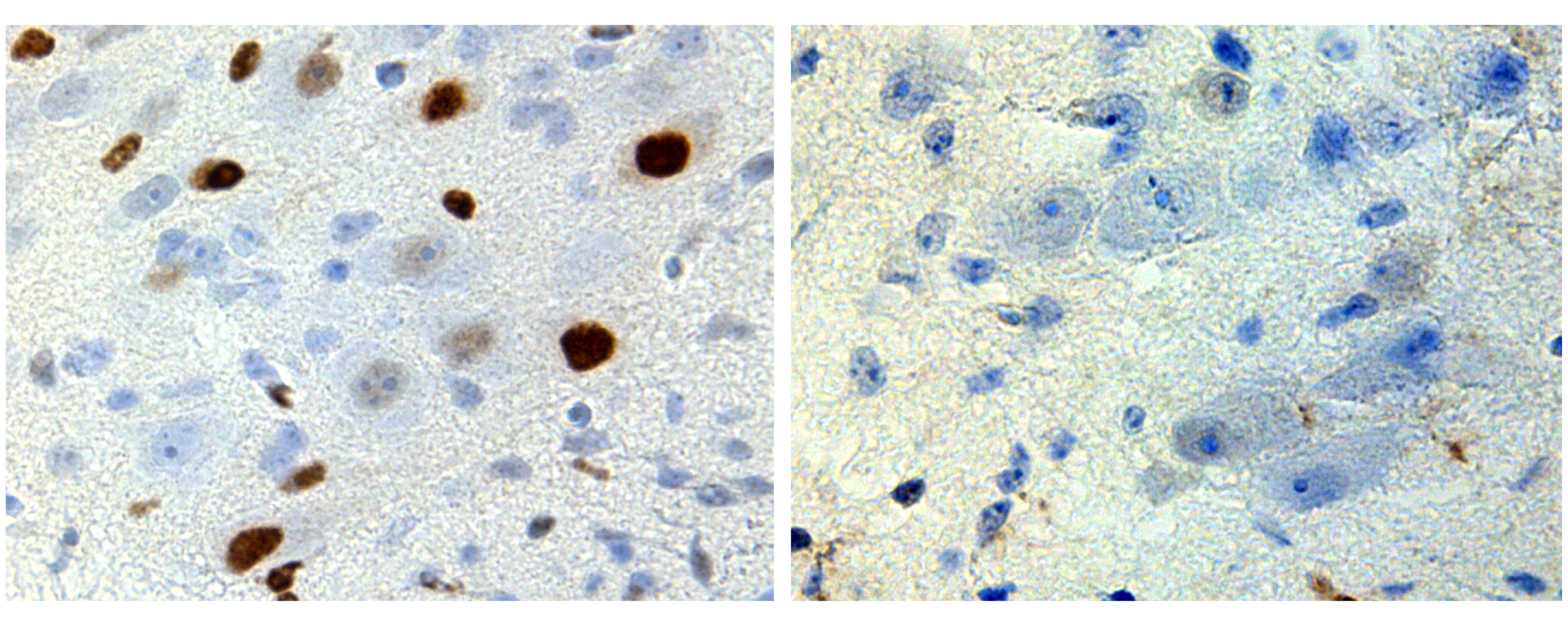 Treating disease at birth: How a brief spike in testosterone sets the trajectory for a disease that appears decades later  