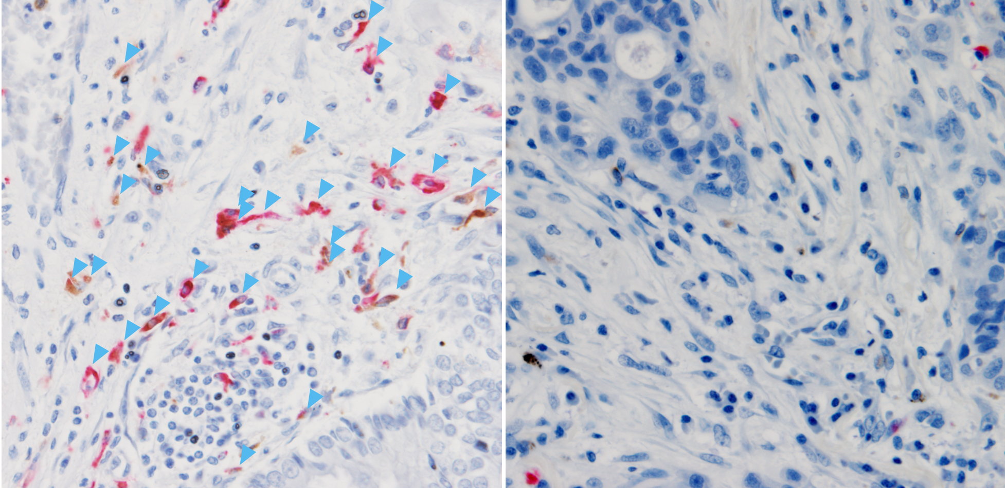 Ancient molecule made inside tumors drives immune response, study finds